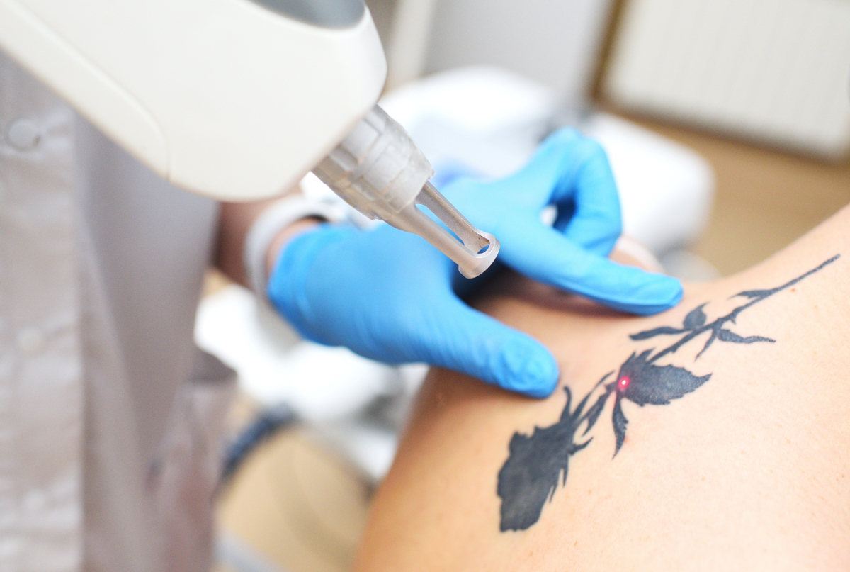 détatouage