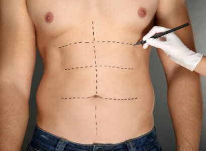 lipofilling