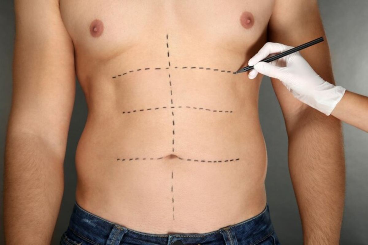 lipofilling