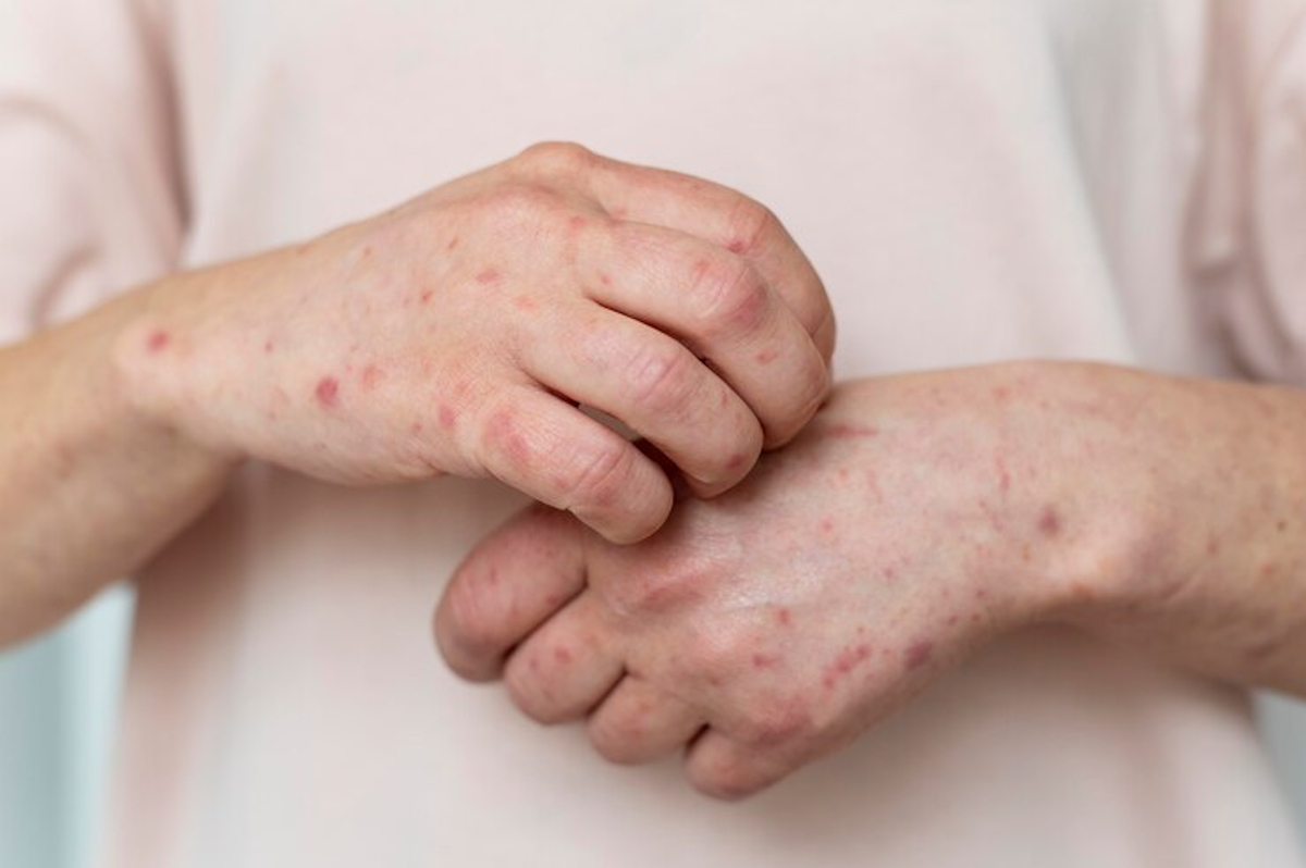 symptômes Érythème polymorphe